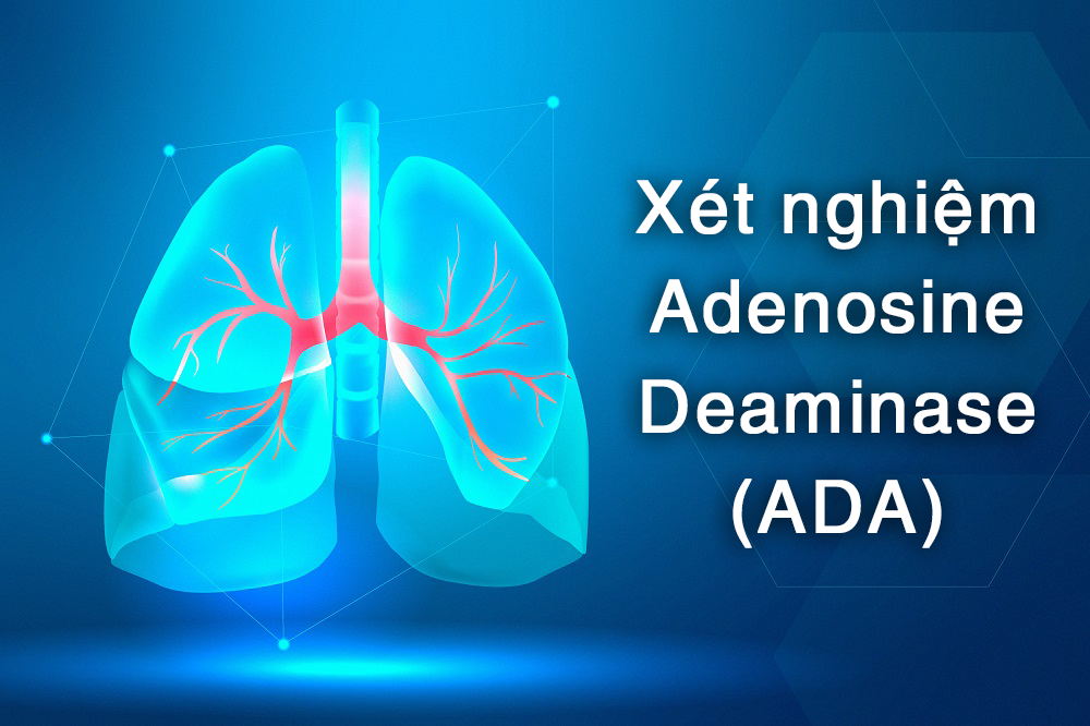 Xét nghiệm ADA và bệnh lao màng phổi